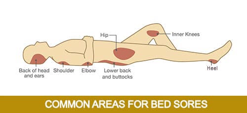 Illustration showing common areas on a human body for bed sores