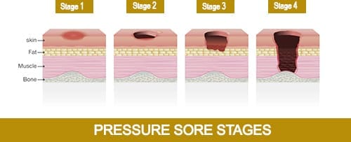 Illustration showing pressure sore stages